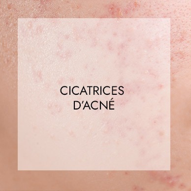 Soins visage haute technologie 4 cicatrice acnee