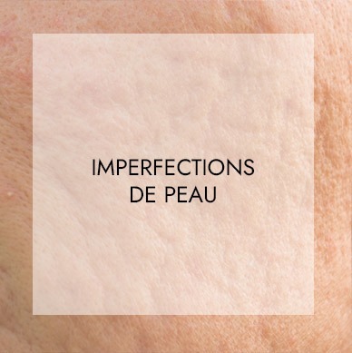 Soins visage haute technologie 3 imperfection peau